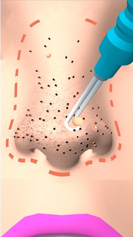 挤黑头大师游戏 挤黑头大师游戏下载